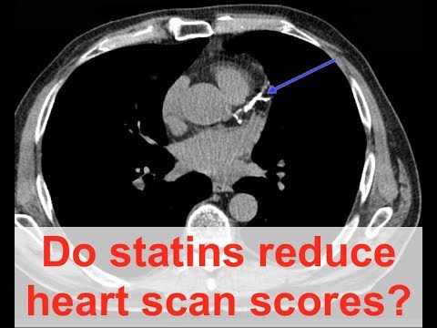 Do statins reduce heart scan scores?